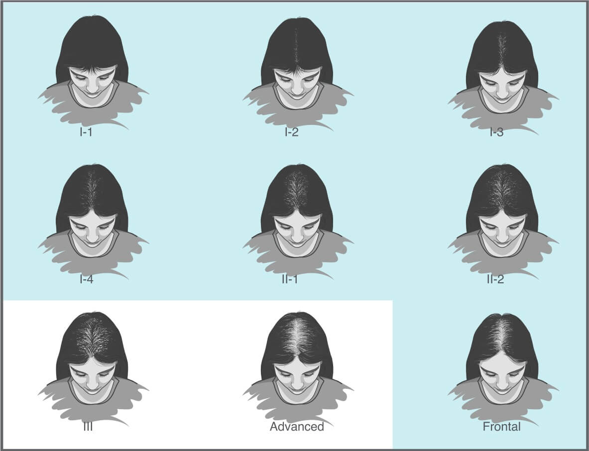 Hair Fall Chart Hair Loss in Women – Novera International/ Capillus
